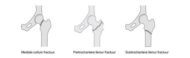 (gebroken heup) - ZorgSaam
